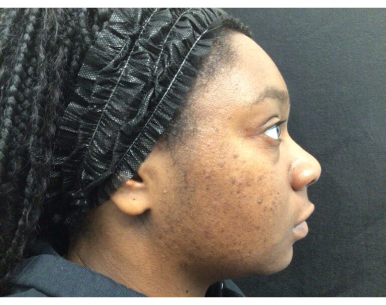 Before Image: Micro - right-side