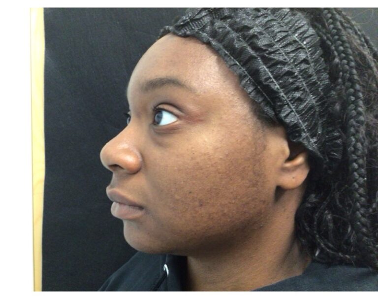 Before Image: Micro - left-front-oblique