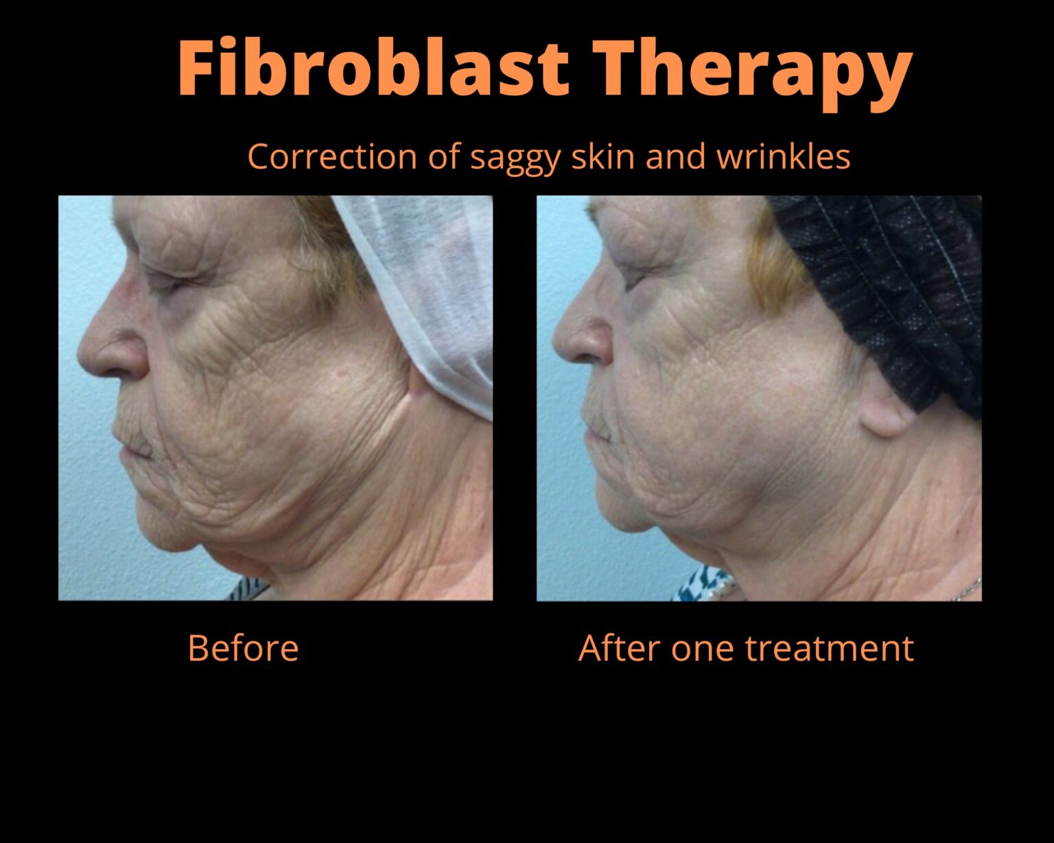 fibroblast-1536x1229 fibroblast-1536x1229