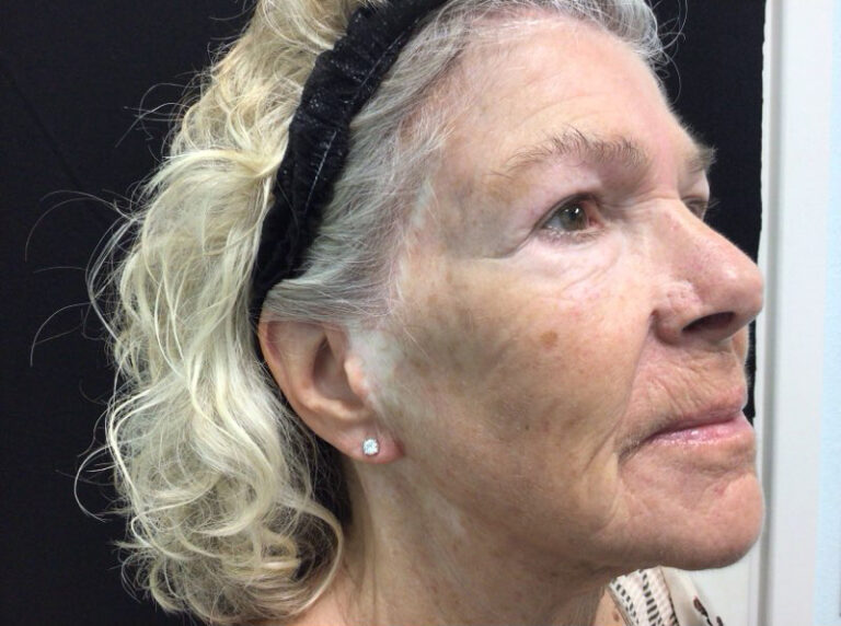 After Image: Micro - right-front-oblique