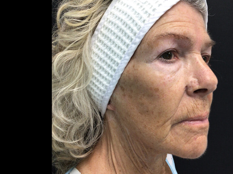 Before Image: Micro - right-front-oblique