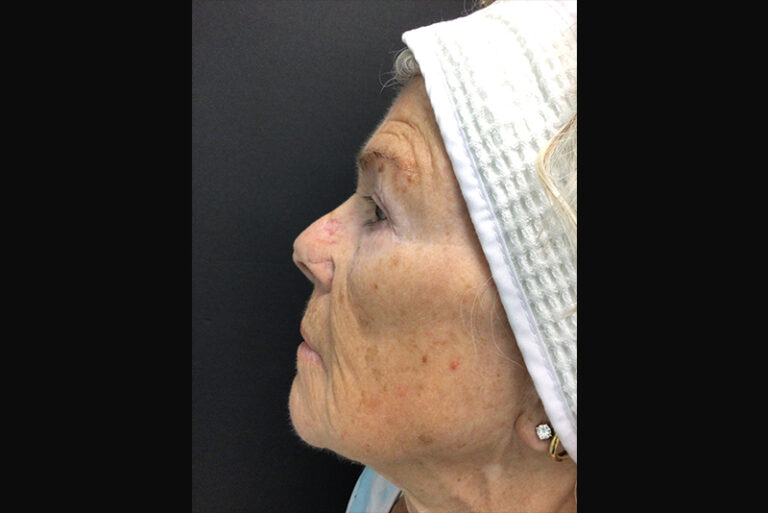 Before Image: Micro - left-side