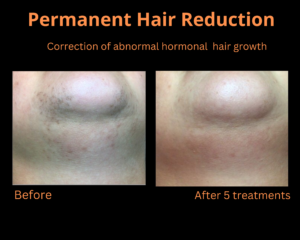 permenanthairreduction-300x240 permenanthairreduction-300x240