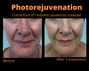 photorejuvenation-300x240 photorejuvenation-300x240