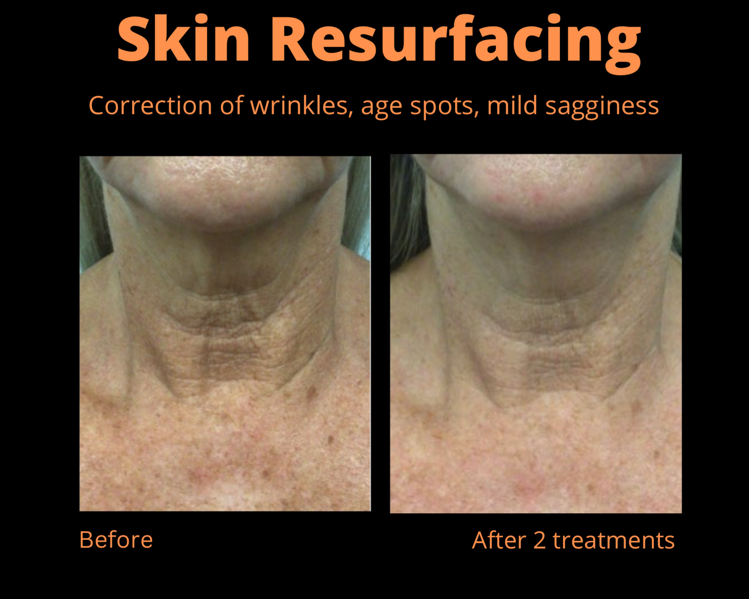 skinresurfacing-1536x1229 skinresurfacing-1536x1229